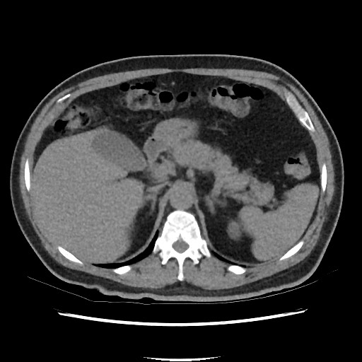 Active colonic bleed on CT (Radiopaedia 49765-55025 Axial non-contrast 20).jpg