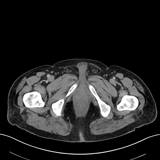 File:Active lower gastrointestinal bleeding - diverticular (Radiopaedia 61203-69106 Axial C+ portal venous phase 138).jpg