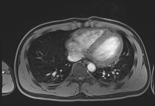 File:Active right ventricular cardiac sarcoidosis (Radiopaedia 55596-62100 Axial Post contrast Dixon 54).jpg