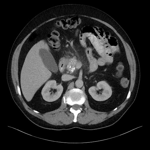 Acute-on-chronic pancreatitis (Radiopaedia 67286-76656 Axial C+ portal venous phase 29).jpg