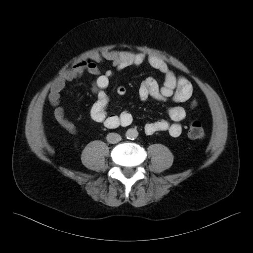 File:Acute-on-chronic pancreatitis (Radiopaedia 67286-76656 Axial C+ portal venous phase 49).jpg
