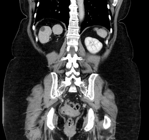 Acute appendicitis, heterotaxy syndrome (Radiopaedia 66884-76202 Coronal C+ portal venous phase 91).jpg