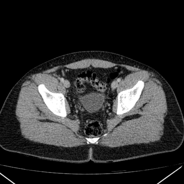 Acute appendicitis (Radiopaedia 38255-40270 Axial C+ portal venous phase 98).jpg