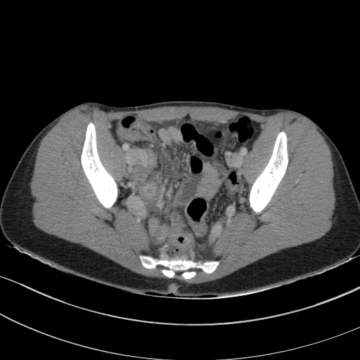 File:Acute appendicitis (Radiopaedia 62608-70901 Axial C+ portal venous phase 34).jpg