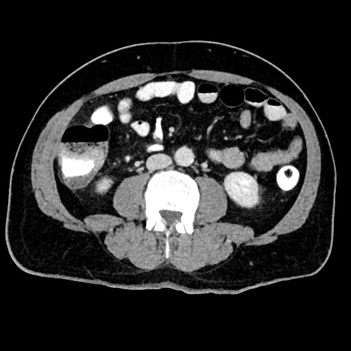 Acute appendicitis (Radiopaedia 77016-88960 Axial C+ portal venous phase 78).jpg