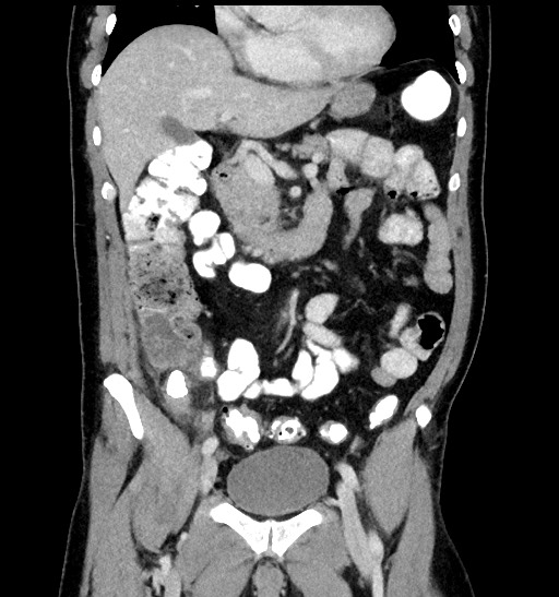 Acute appendicitis (Radiopaedia 77016-88960 Coronal C+ portal venous phase 44).jpg
