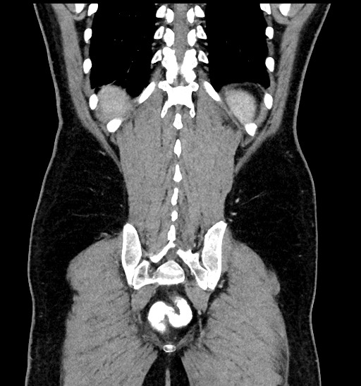 File:Acute appendicitis (Radiopaedia 77016-88960 Coronal C+ portal venous phase 81).jpg