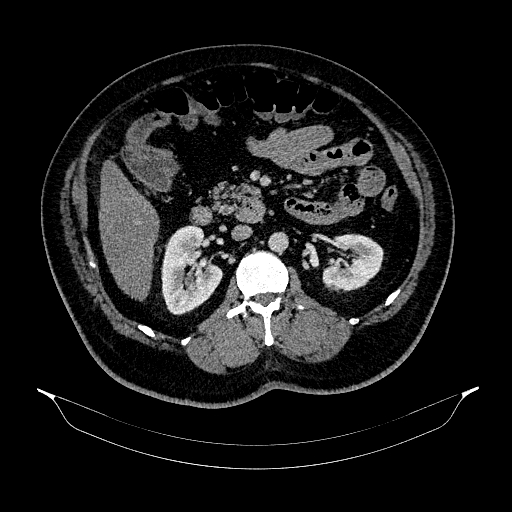 Acute appendicitis (Radiopaedia 79950-93224 Axial C+ portal venous phase 45).jpg