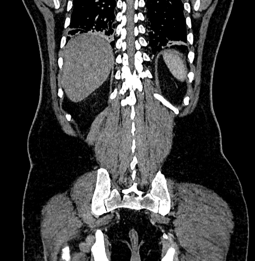 Acute appendicitis (Radiopaedia 79950-93224 Coronal C+ portal venous phase 77).jpg