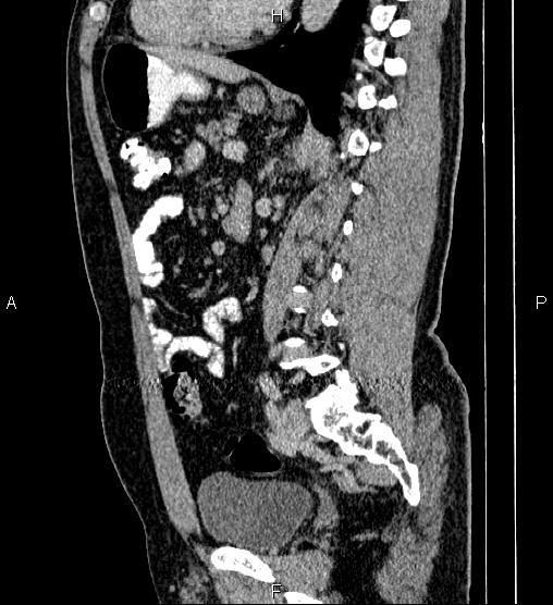 Acute appendicitis (Radiopaedia 84780-100240 Sagittal C+ portal venous phase 62).jpg