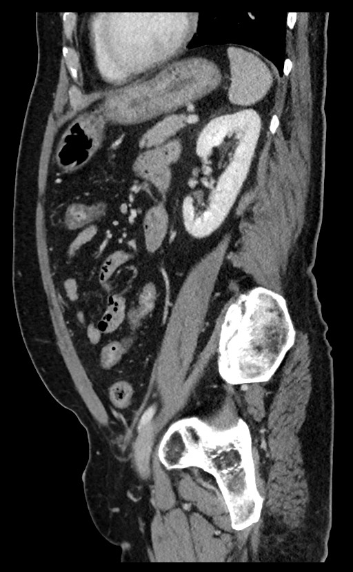 Acute appendicitis - large appendicoliths (Radiopaedia 61805-69820 Sagittal C+ portal venous phase 38).jpg