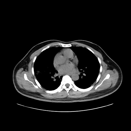 Acute appendicitis and COVID 19 pneumonia (Radiopaedia 76604-88380 Axial non-contrast 28).jpg