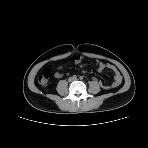 Acute appendicitis and COVID 19 pneumonia (Radiopaedia 76604-88380 Axial non-contrast 86).jpg