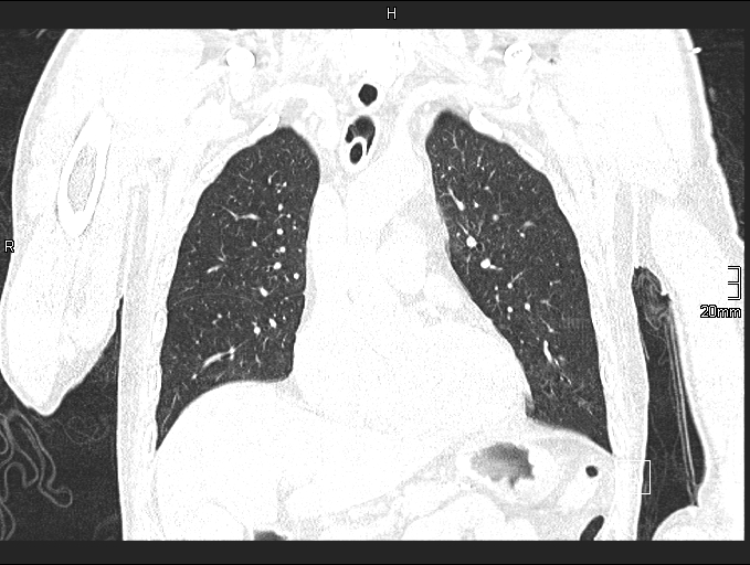 Acute aspiration pneumonitis (Radiopaedia 55642-62166 Coronal lung window 37).jpg