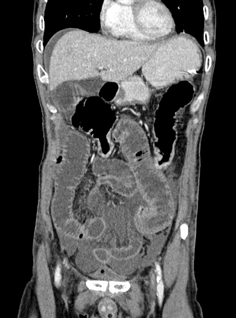 Acute bowel ischemia (Radiopaedia 87695-104114 Coronal C+ portal venous phase 139).jpg