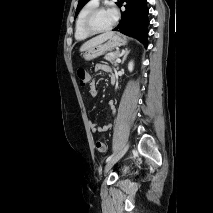Acute cholecystitis and incidental left sided IVC (Radiopaedia 49352-54459 Sagittal C+ portal venous phase 37).jpg