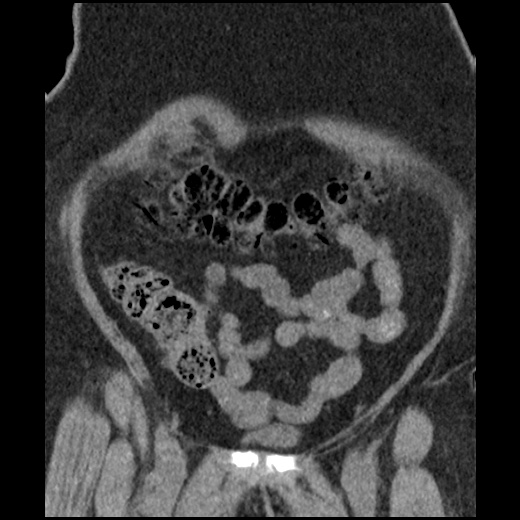 Acute cholecystitis and ureteric colic (Radiopaedia 42330-45444 Coronal prone 27).jpg