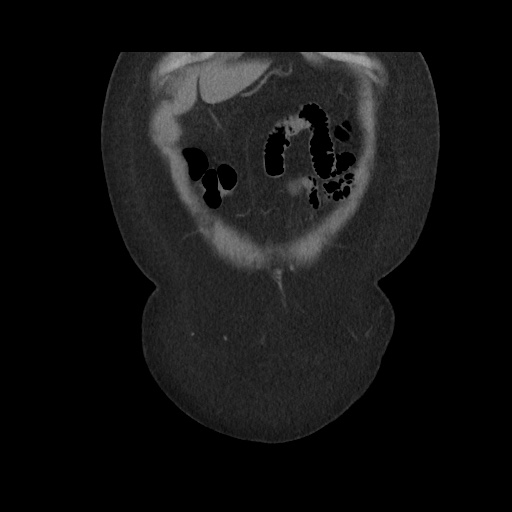 Acute cholecystitis with tensile fundus sign (Radiopaedia 71394-81723 Coronal non-contrast 26).jpg