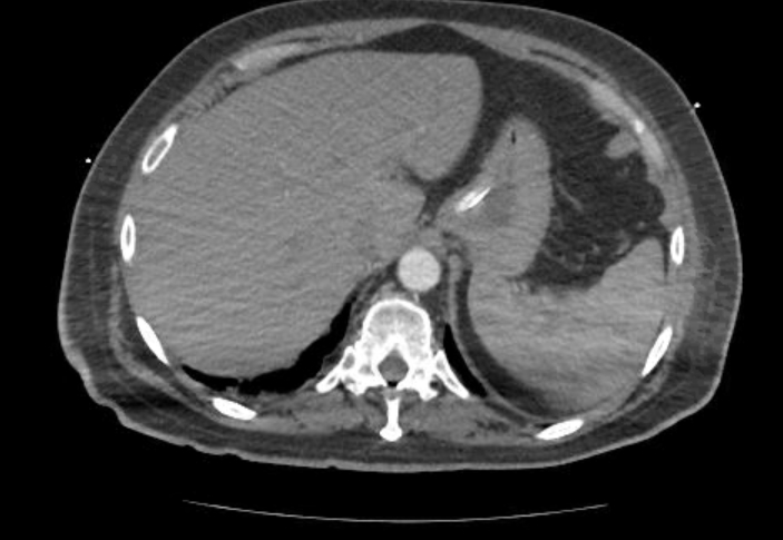 Acute cor pulmonale (ultrasound) (Radiopaedia 83508-98818 Axial C+ CTPA 79).jpg