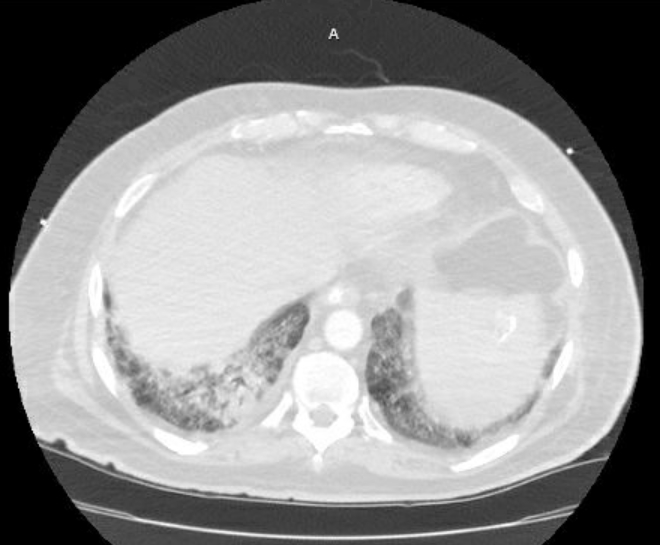 Acute cor pulmonale (ultrasound) (Radiopaedia 83508-98818 Axial lung window 72).jpg