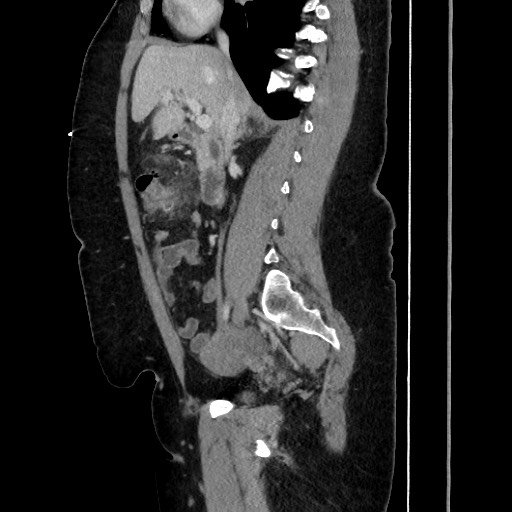Acute diverticulitis - transverse colon (Radiopaedia 87063-103327 Sagittal C+ portal venous phase 104).jpg