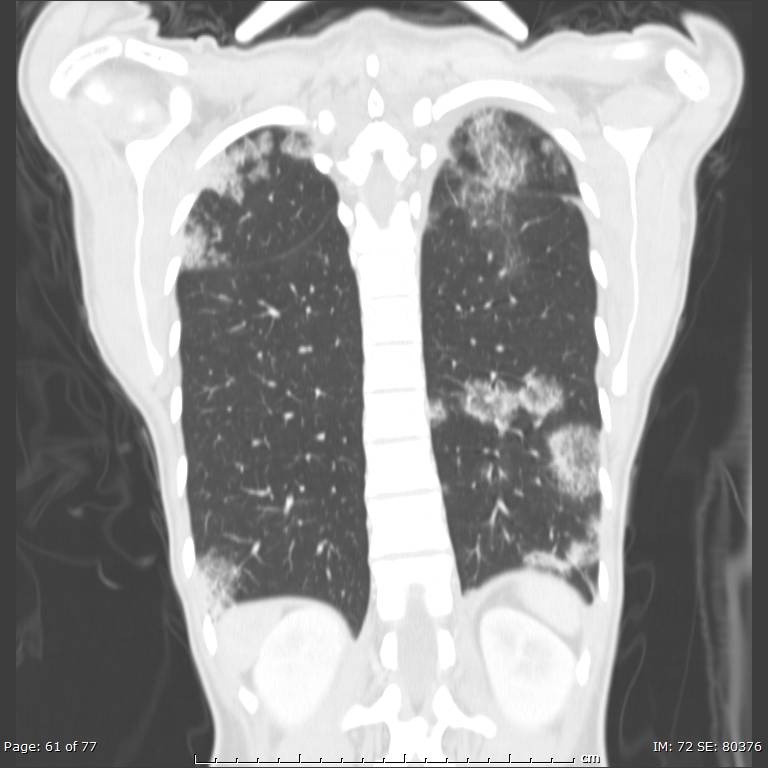 Acute eosinophilic pneumonia (Radiopaedia 48211-53073 Coronal lung window 42).jpg