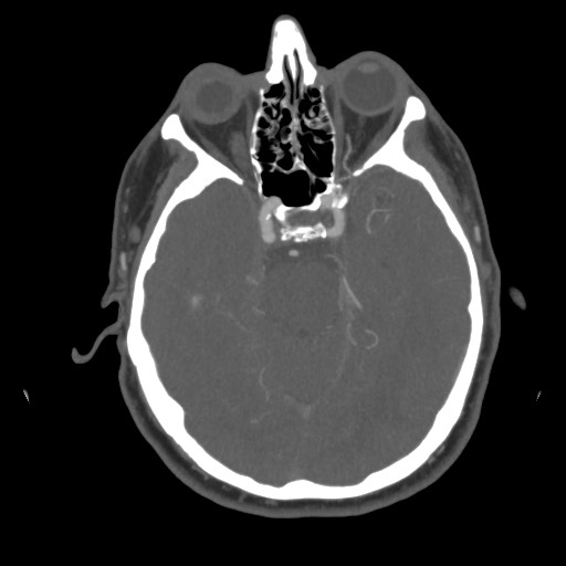File:Acute internal carotid artery dissection (Radiopaedia 53541-59630 D 29).jpg