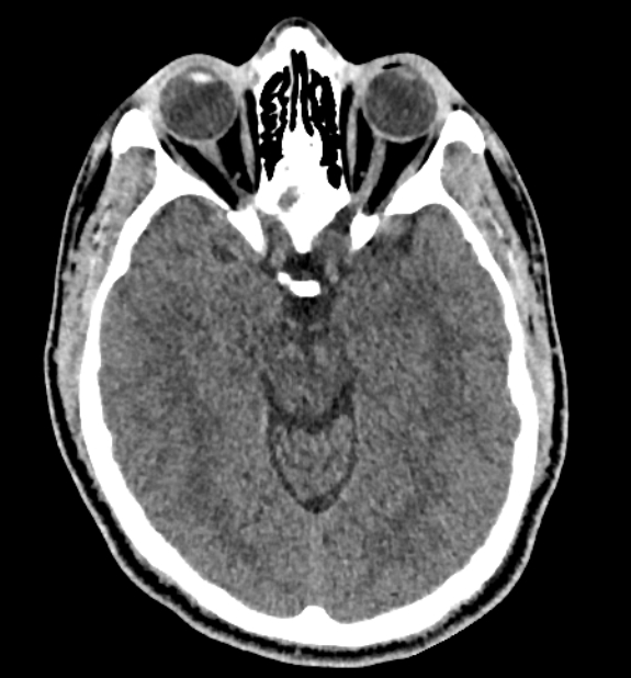 Acute ischemic stroke - posterior circulation territory (Radiopaedia 77670-89881 non-contrast 34).jpg