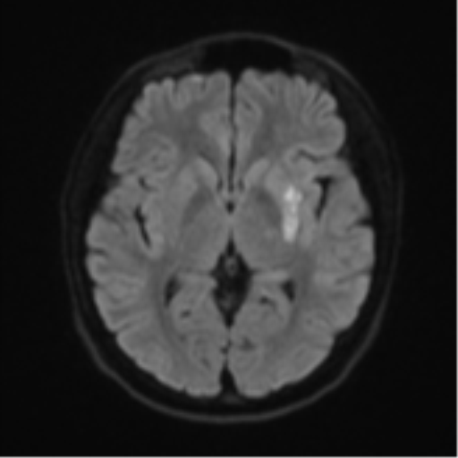 Acute left middle cerebral artery territory infarct with clot retrieval (Radiopaedia 47732-52433 Axial DWI 45).png