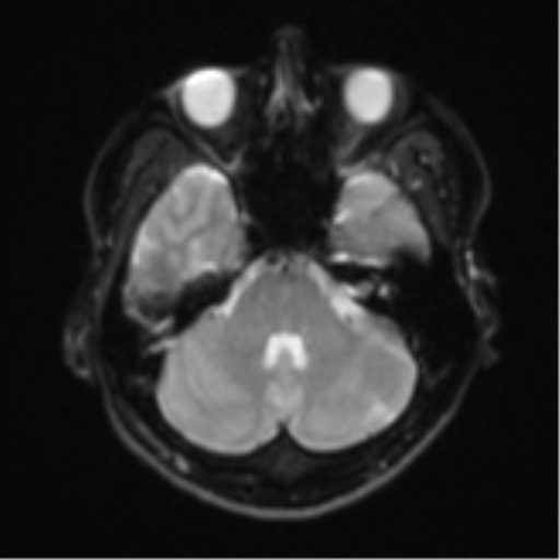 Acute left middle cerebral artery territory infarct with clot retrieval (Radiopaedia 47732-52433 Axial DWI 8).png