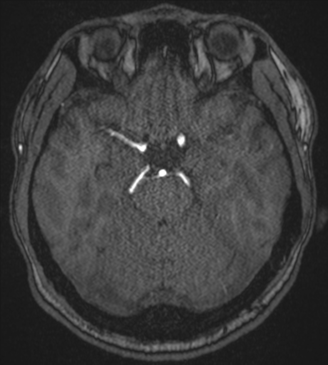 Acute left middle cerebral artery territory infarct with clot retrieval (Radiopaedia 47732-52433 Axial MRA 22).png