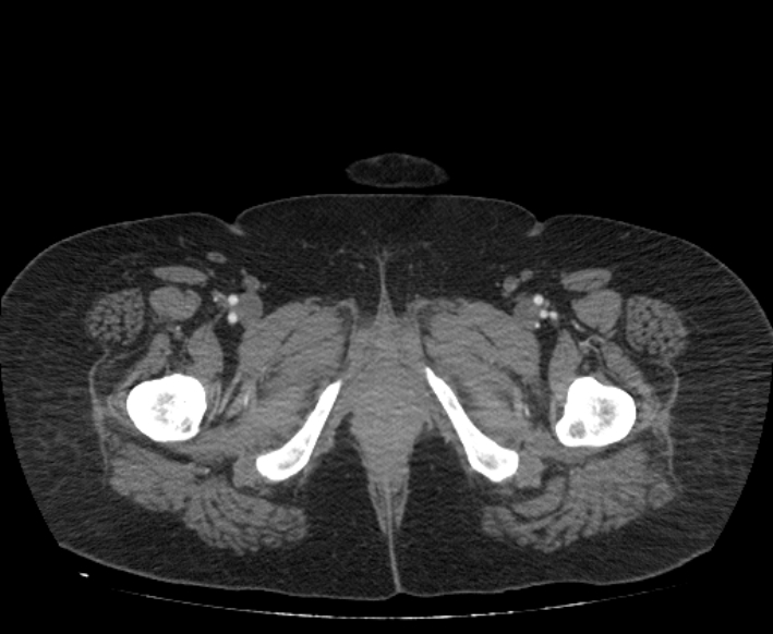 Acute mesenteric ischemia (Radiopaedia 80029-93316 Axial C+ arterial phase 144).jpg