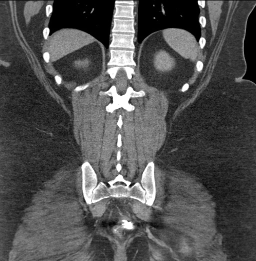 Acute mesenteric venous ischemia (Radiopaedia 46041-50383 Coronal C+ portal venous phase 77).jpg