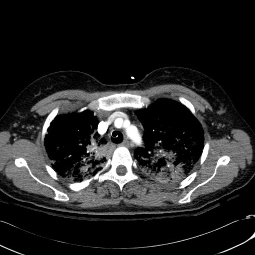 Acute myocardial infarction in CT (Radiopaedia 39947-42415 Axial C+ arterial phase 33).jpg