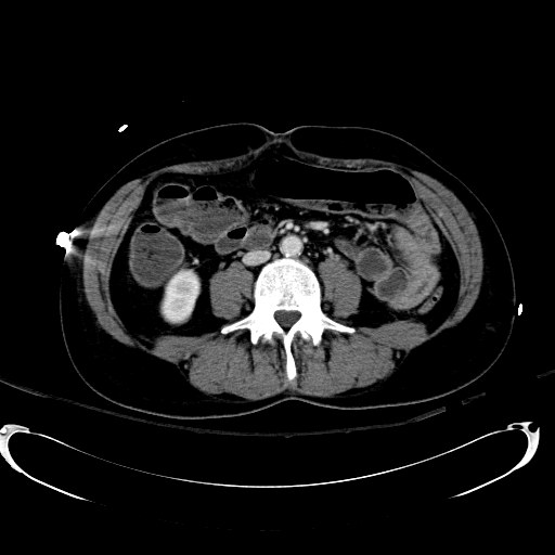 Acute myocardial infarction in CT (Radiopaedia 39947-42415 Axial C+ portal venous phase 72).jpg