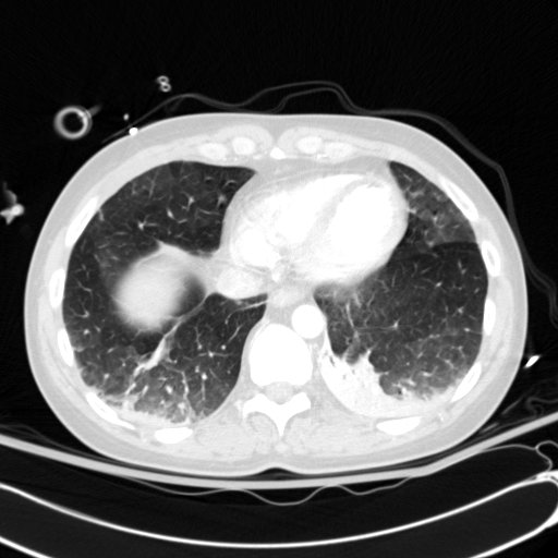 Acute myocardial infarction in CT (Radiopaedia 39947-42415 Axial lung window 103).jpg