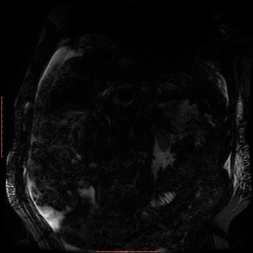 File:Acute necrotizing pancreatitis (Radiopaedia 28194-28448 Coronal MRCP 54).jpg