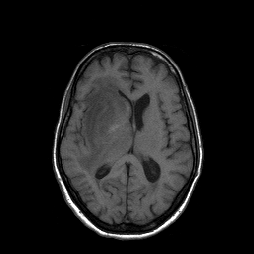 File:Acute necrotizing toxoplasma encephalitis (Radiopaedia 10683-11149 Axial T1 8).jpg