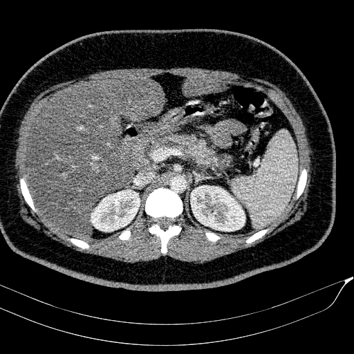 Acute on chronic pancreatitis (Radiopaedia 80902-94423 Axial C+ portal venous phase 51).jpg
