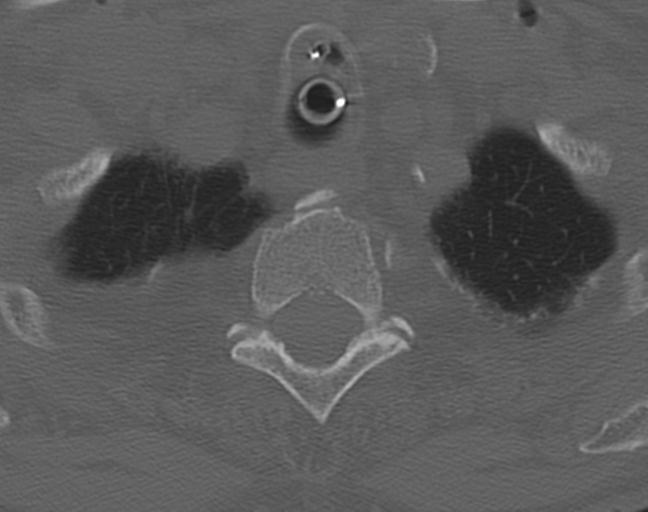 Acute on chronic subdural hematoma and thoracic vertebral injury in a multitrauma patient (Radiopaedia 31698-32619 Axial bone window 59).jpg