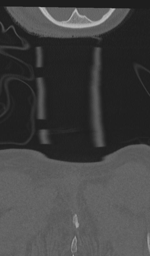 Acute on chronic subdural hematoma and thoracic vertebral injury in a multitrauma patient (Radiopaedia 31698-32619 Coronal bone window 79).jpg