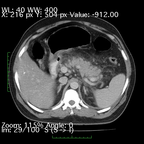 Acute pancreatitis (Radiopaedia 34043-35276 Axial C+ portal venous phase 29).jpg