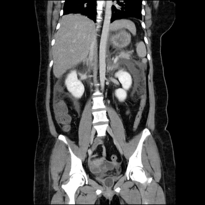 Acute pancreatitis (Radiopaedia 69236-79012 Coronal C+ portal venous phase 36).jpg