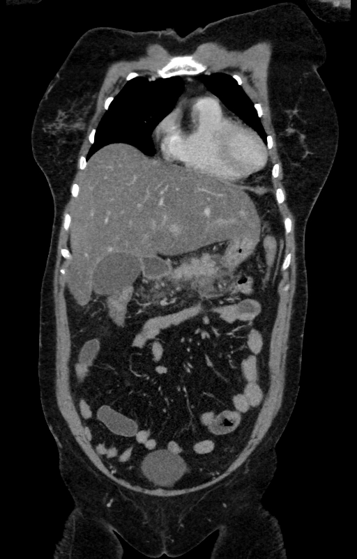 Acute pancreatitis (Radiopaedia 80007-93285 Coronal C+ portal venous phase 28).jpg