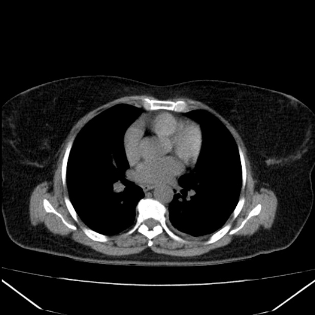 Acute pancreatitis - Balthazar C (Radiopaedia 26569-26714 Axial non-contrast 4).jpg