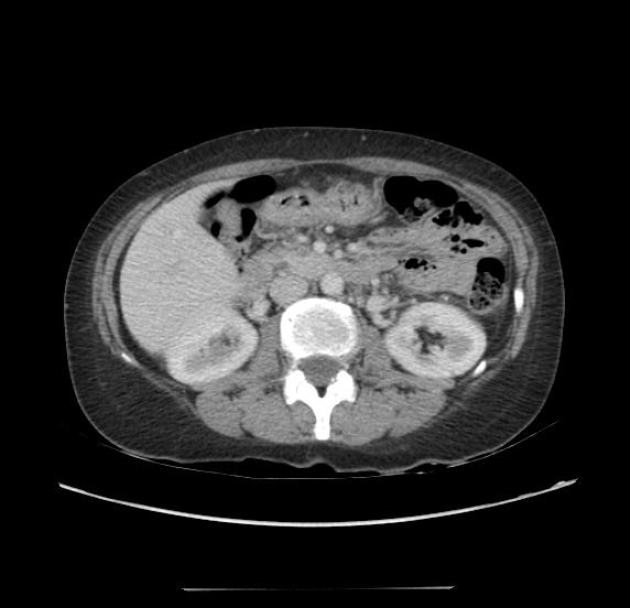 Acute pancreatitis - Balthazar E - post ERCP (Radiopaedia 27562-27772 Axial C+ portal venous phase 32).png