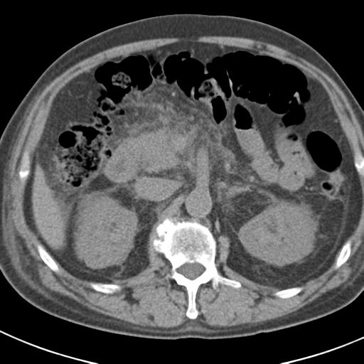 File:Acute pancreatitis and walled-off necrosis (Radiopaedia 29888-30403 Axial non-contrast 25).jpg