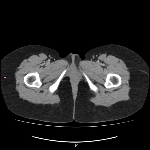 Acute pancreatitis secondary to stone at minor papilla and pancreatic divisum (Radiopaedia 76570-88333 Axial C+ portal venous phase 89).jpg