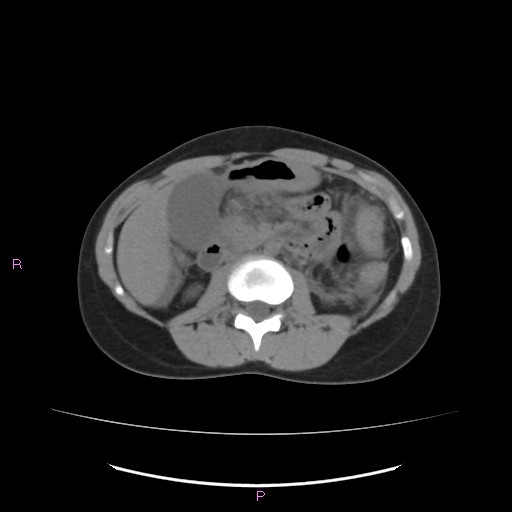 Acute pancreatitis secondary to stone at minor papilla and pancreatic divisum (Radiopaedia 76570-88333 Axial non-contrast 33).jpg