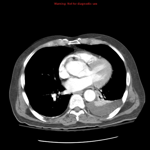 File:Acute pancreatitis with incidental pancreatic lipoma (Radiopaedia 10190-10730 Axial C+ arterial phase 3).jpg